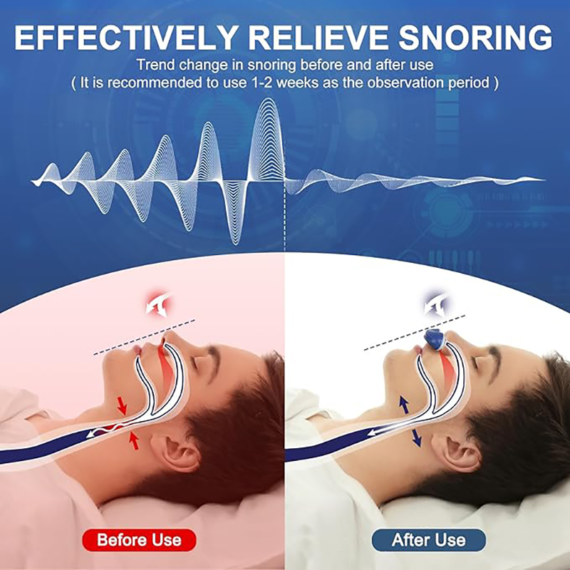 Electric Anti Snoring Device QC-001, Rechargeable Snore Stopper for Better Sleep, Silent Micro-CPAP Nose Vents Aid for Men & Women - Image 3